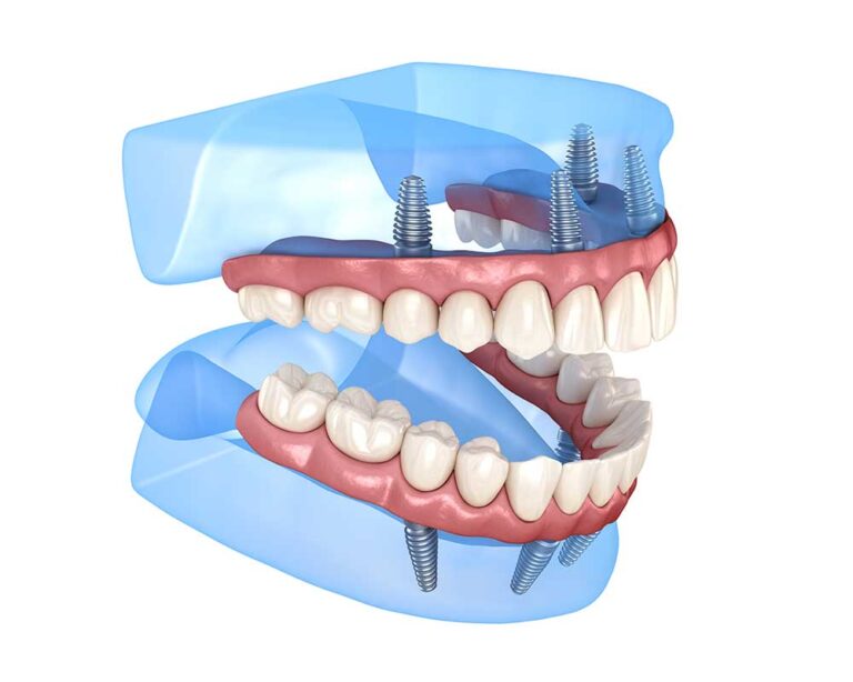 Anchored Dentures Dental Implants Denver