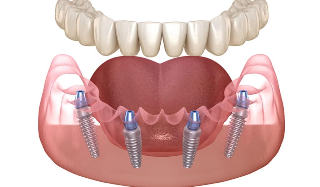 All On Four Dental Implants