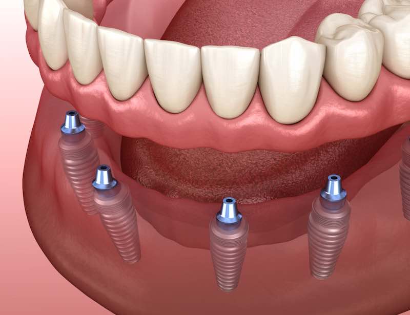 dental-implants-in-denver