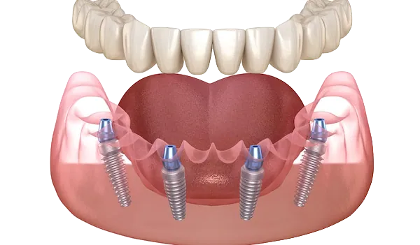 All On Four Dental Implants