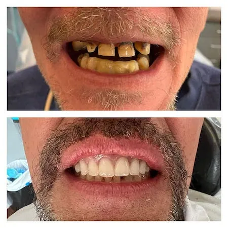 Dental Implant before & after