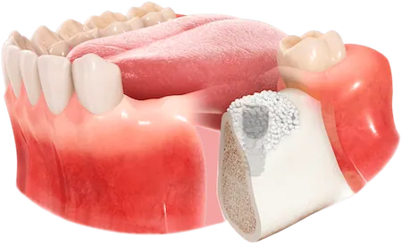 Dental bone graft