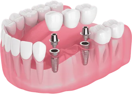 Dental Implant Bridge