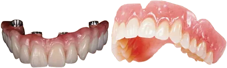 Implants versus dentures