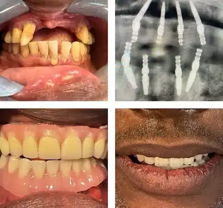 Patient with missing teeth, before and after implant