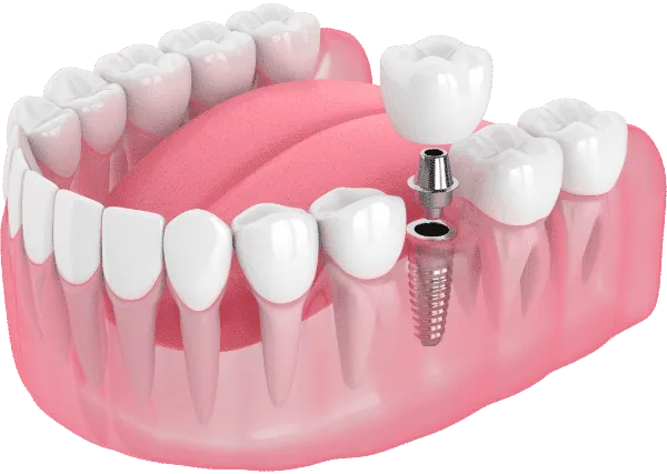 Single dental implants