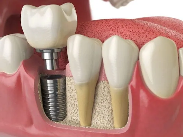 Single Tooth Implant