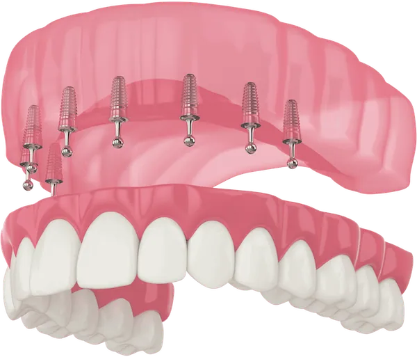 Snap-On Dentures