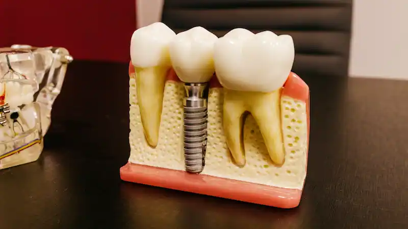 Dental Implant 3D model