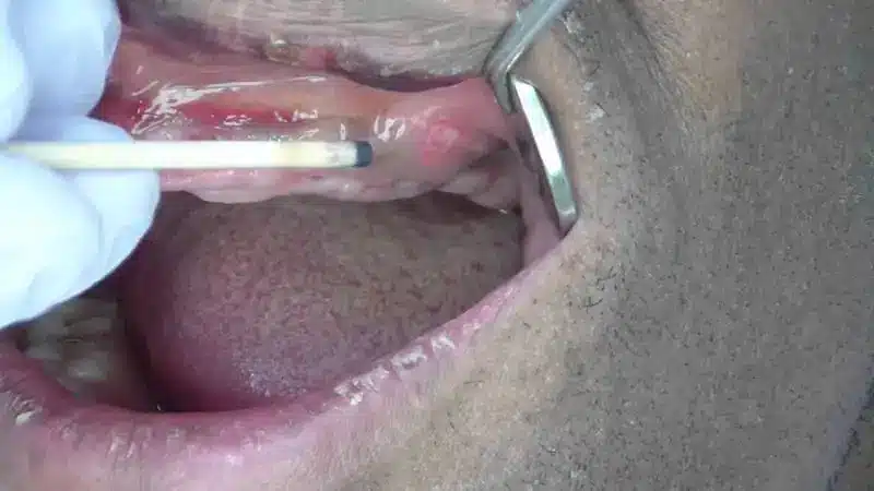 A sore spot on a patient's gum due to dentures