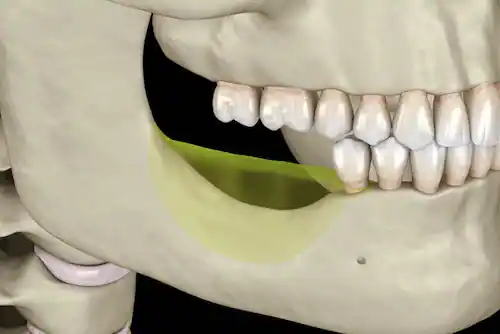 Jaw bone loss due to missing teeth