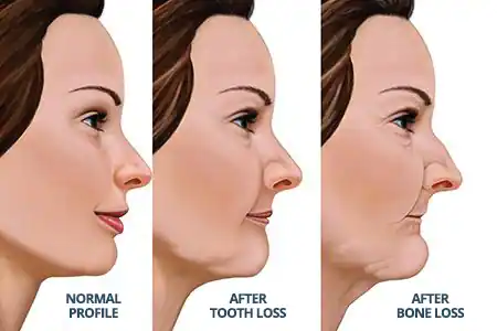 Missing teeth and bone loss