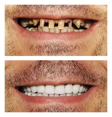 Dental implant, before and after