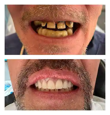 Dental implant, before and after