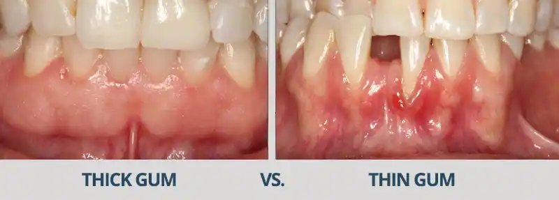 Thick gum vs thin gum