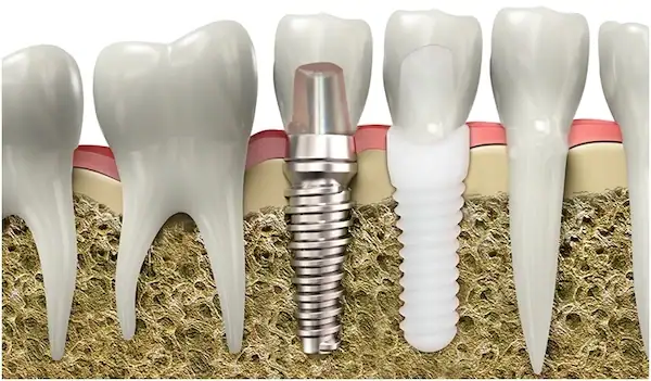 Titanium versus Zirconia