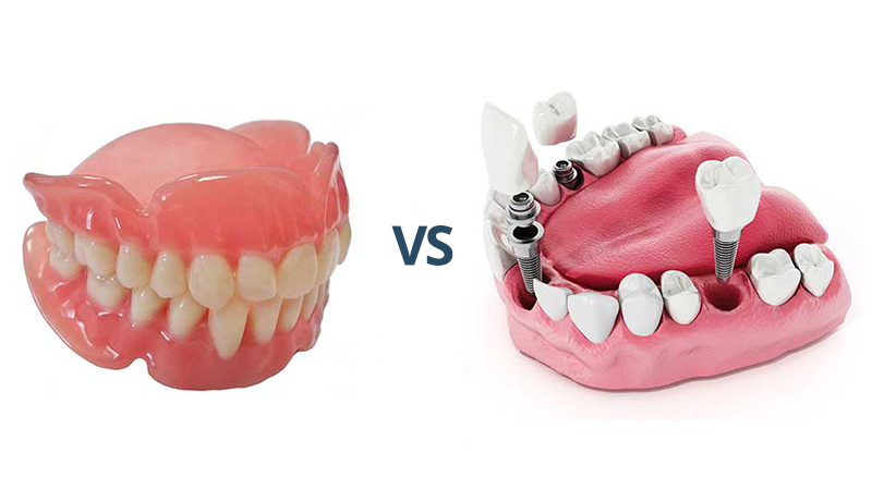 Dentures vs. dental implants
