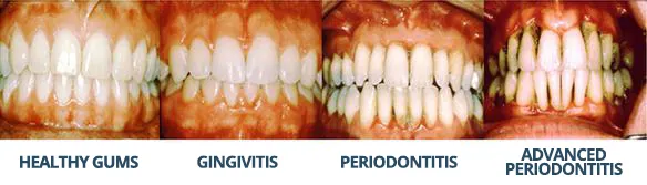 Periodontal disease stages