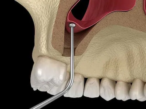 Sinus lift