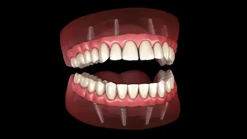 All-On-4 Dental Implants