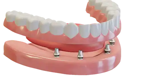 Anchored dentures