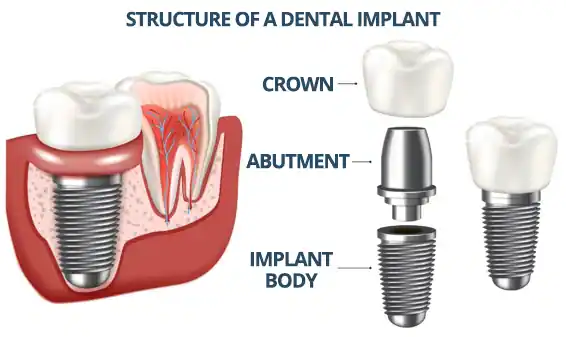Dental Implant System