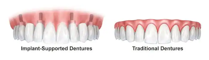 Prótesis dentales vs. prótesis dentales soportadas por implantes