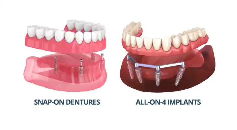 Snap-on Dentures vs. All-On-4 Implants