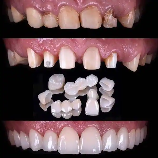 Full mouth reconstruction with dental crowns
