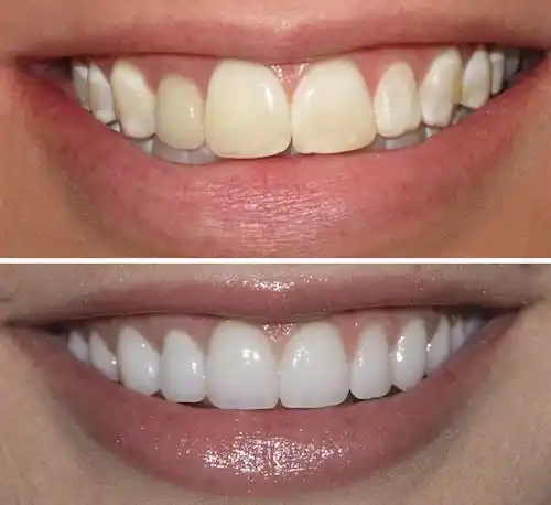 Teeth whitening before and after