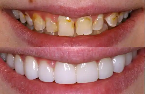 Veneers: before and after