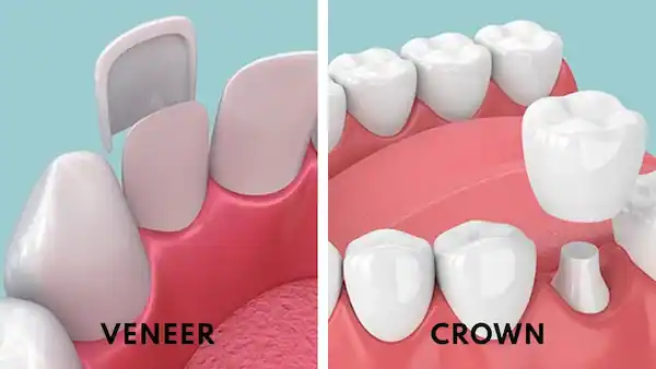 Veneers vs. crowns