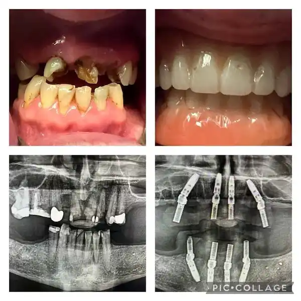 Dental Implants X-Rays