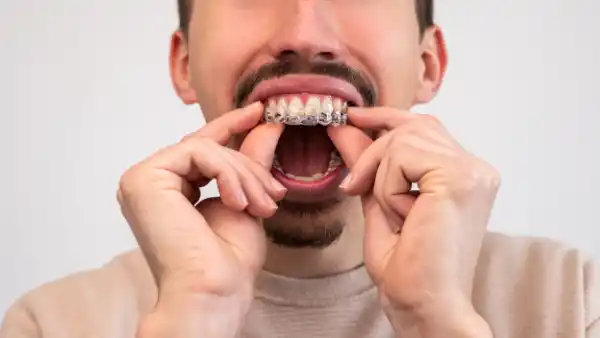 Invisalign