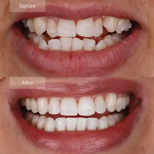 Invisalign