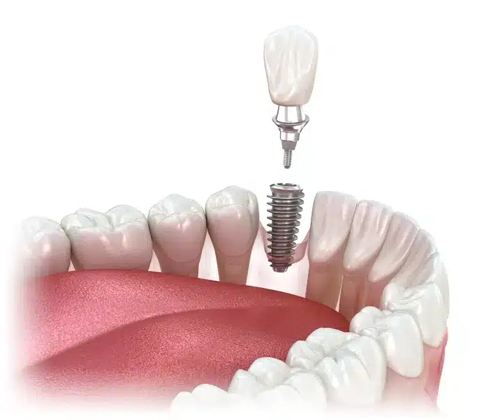 single dental implants