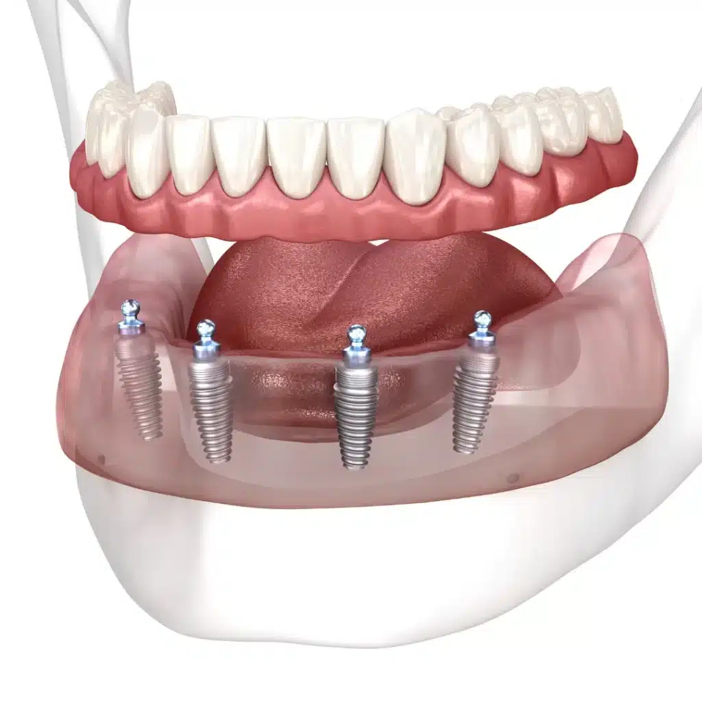 Full Mouth Dental Implants