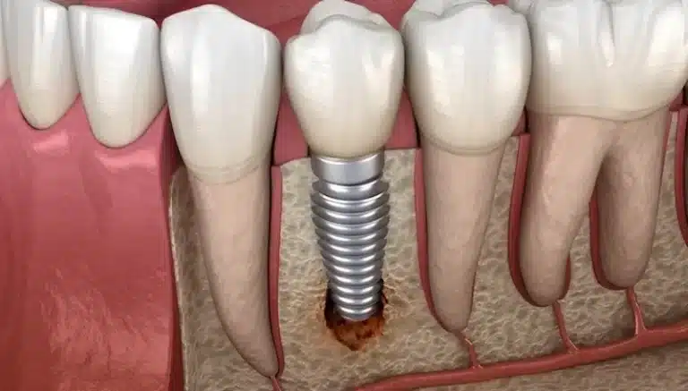 Dental Implant Infection