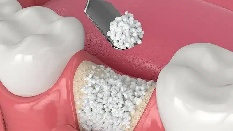 Bone grafting