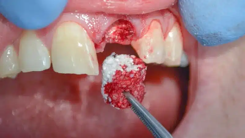 Bone grafting