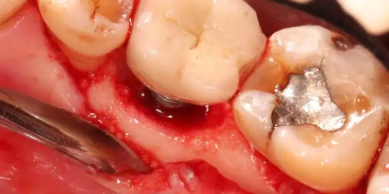 Dental Implant Infection