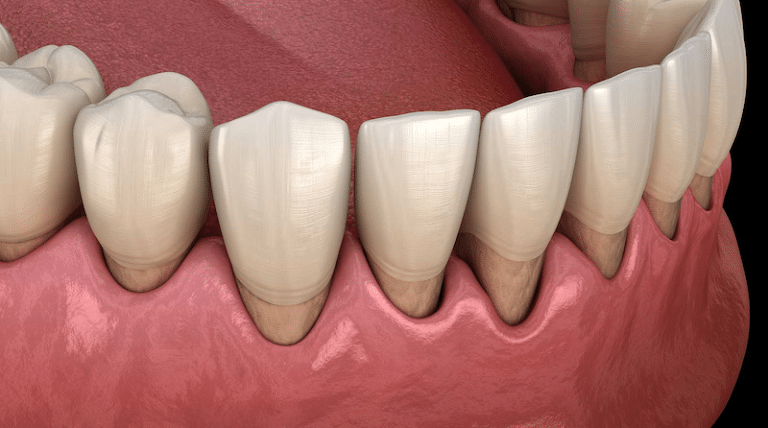 Periodontal disease