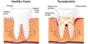 Periodontitis