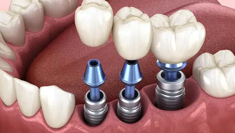 Titanium dental implants