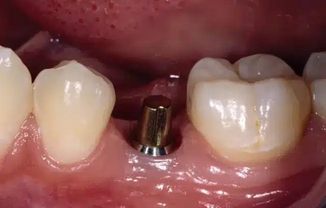 Dental Implant Abutment