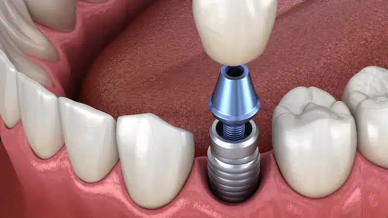 Dental Implant Abutment