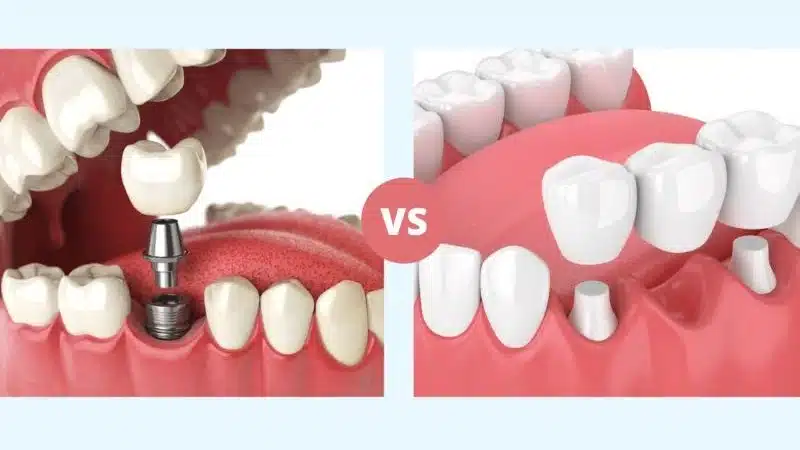 Dental Implants vs Dental Bridges