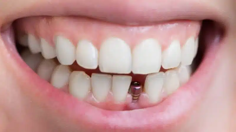 Mini dental implants