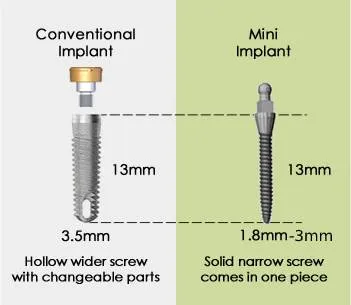 Mini dental implants vs. traditional implants