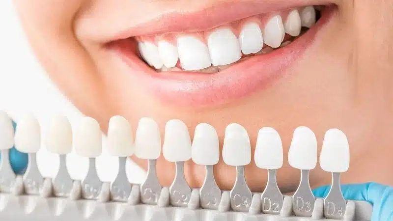 Teeth Whitening